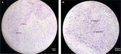 Treatment of Recurrent Undifferentiated Pleomorphic Sarcoma of Infratemporal Fossa by Surgery Combined With Carbon Ion Radiotherapy: One Case Report